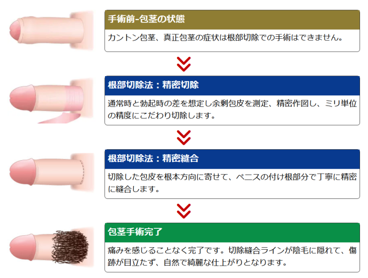 根部切除法（バックカット）MSクリニック