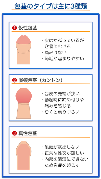 包茎のタイプは主に3種類